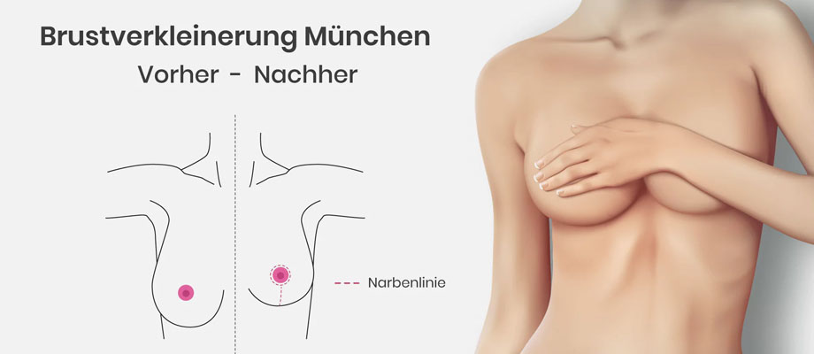 dr. maximilian eder – brustverkleinerung grafik vorher-nachher